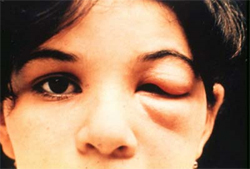 Swollen eye of young girl with Chagas disease.